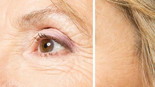 درمان چین و چروک