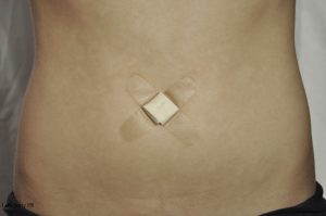 ناف هراسی فوبیا ناف هراسی فوبیا