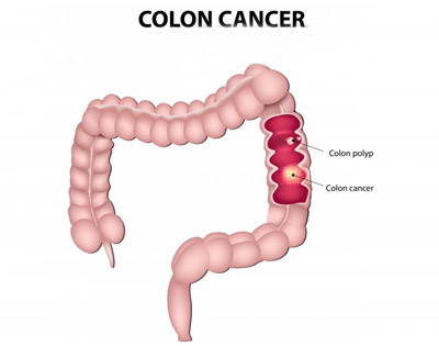 انسداد روده چیست و چگونه قابل درمان است؟