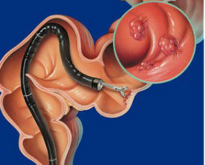 انسداد روده چیست و چگونه قابل درمان است؟