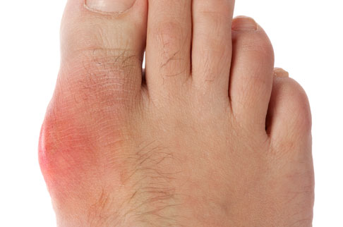 درمان نقرس با طب سنتی و گیاهان دارویی