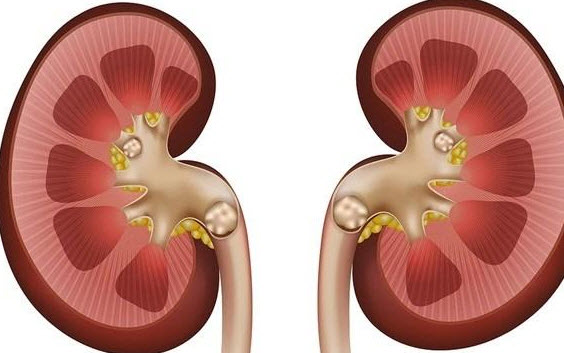 پیشگیری از سنگ کلیه با رعایت خوردن مواد غذایی