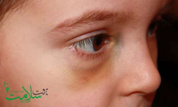 رفع کبودی زیر چشم