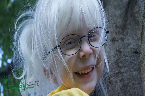 آلبینیسم