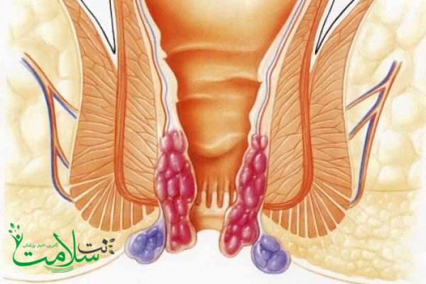 پیشگیری از بواسیر پیشگیری از بواسیر